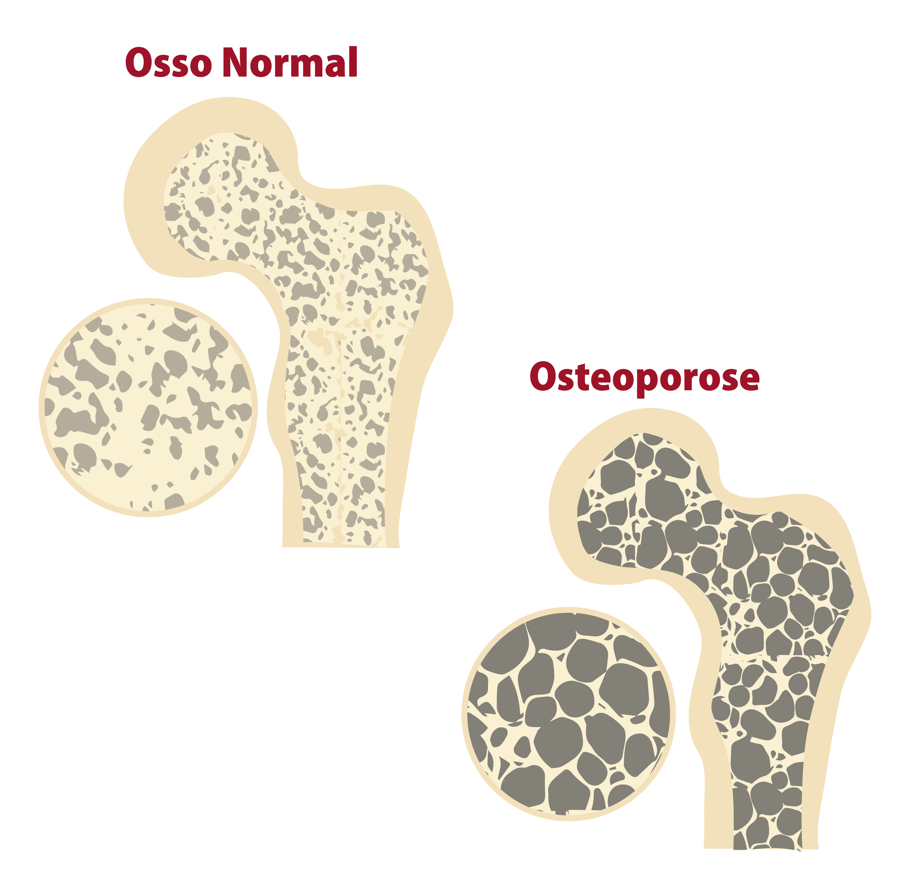 osteoporose imagem