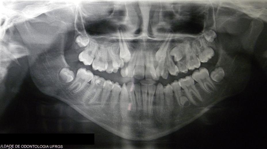 Radiografia Panorâmica da mandíbula não evidencia lesões sugestivas de