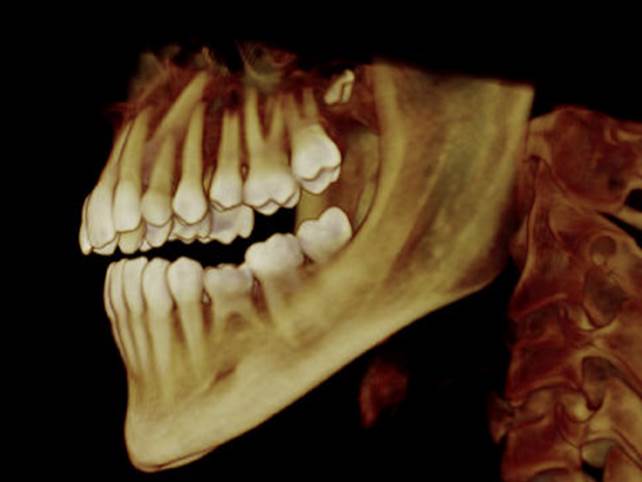 1 pçs dental baixo maxilar mandíbula tecido mandíbula anatômico